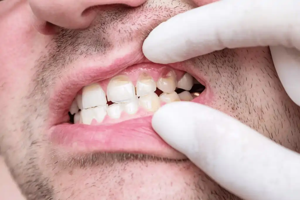 Could My Everyday Habits Be Slowly Damaging My Tooth Enamel Without Me Knowing Oxfordshire